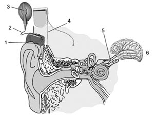 1. Headset 2. Cable to speed processor 3. Microphone 
      4. Implant 5. Auditory Nerve 6. Brain