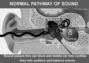 Normal pathway of sound.